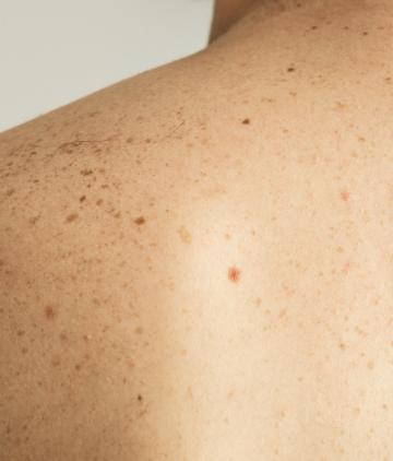 moles-freckles